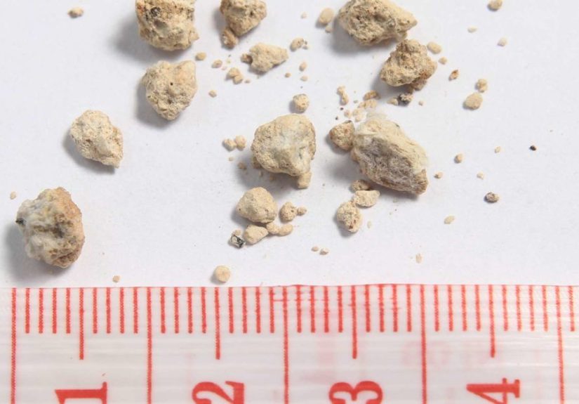 Certain antibiotics increase kidney stone risk