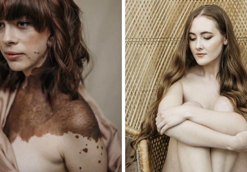 For This International Women’s Day We Did A Special Photoshoot With Women That Represent People With Disabilities And Visible Differences