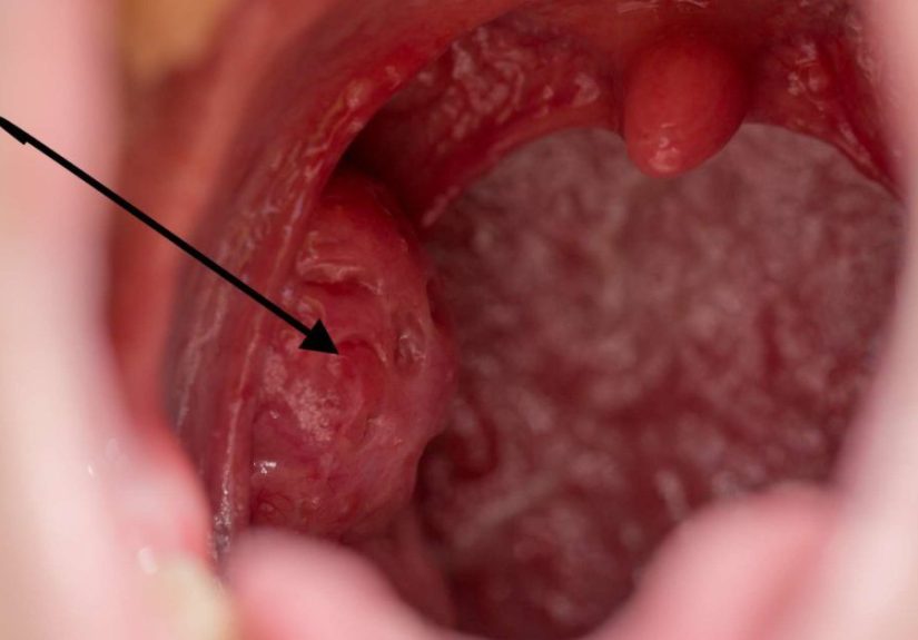 Holes in tonsils: Causes, symptoms, and treatment