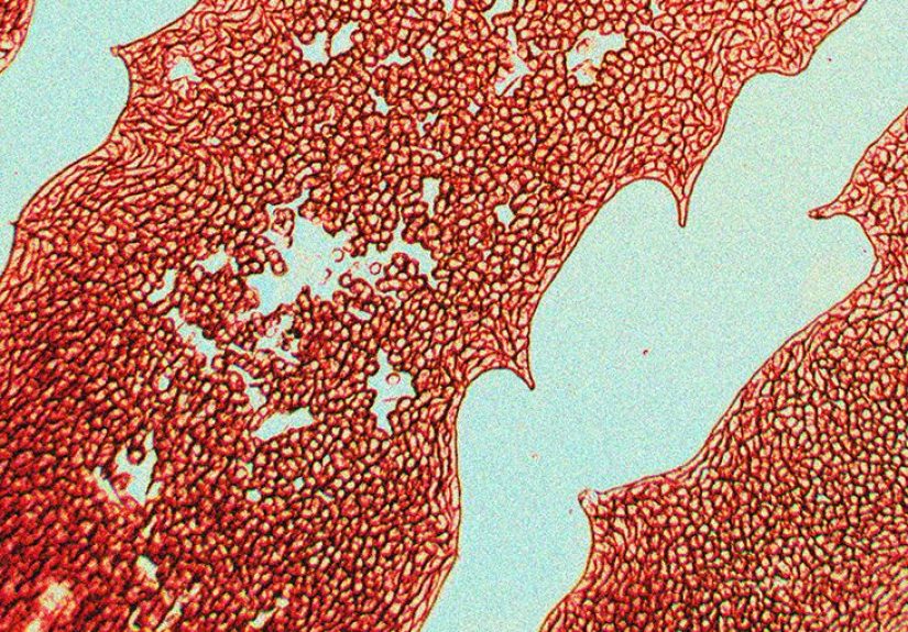 Lung cancer blood clots: Causes, severity, and more