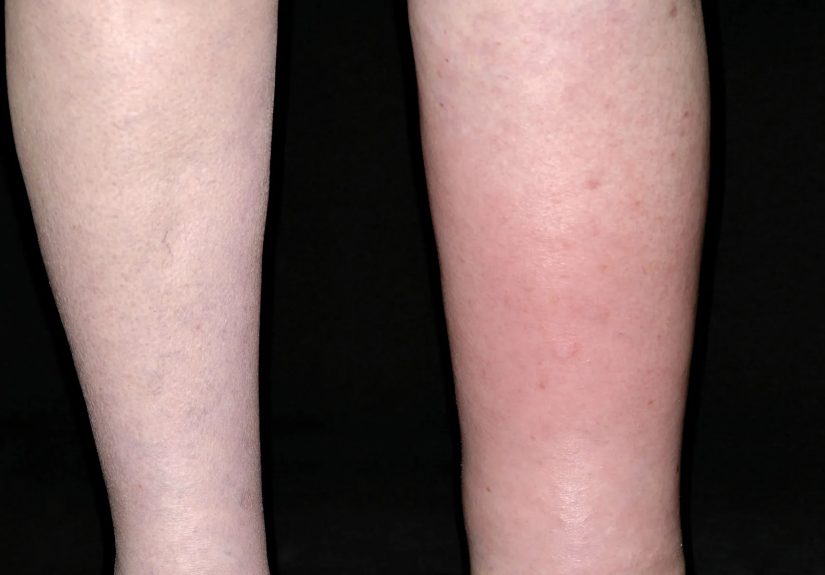 Lymphedema After Breast Cancer Surgery