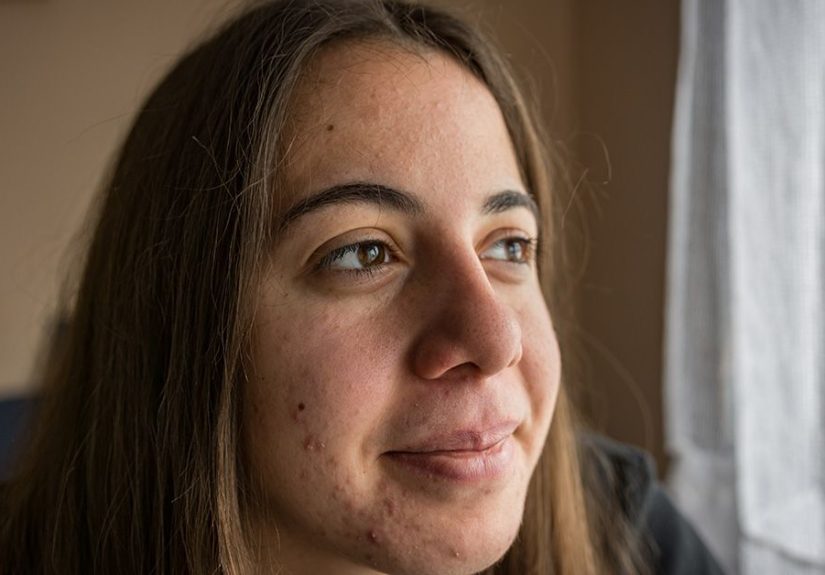 Pimple That Won’t Go Away: Causes, Symptoms, and Treatments