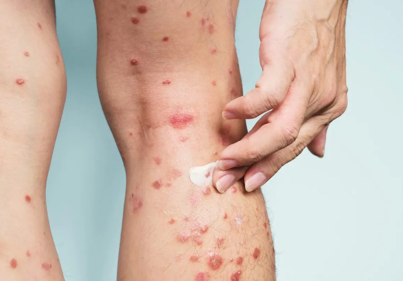 Psoriasis Spotting and Scarring: How to Cope