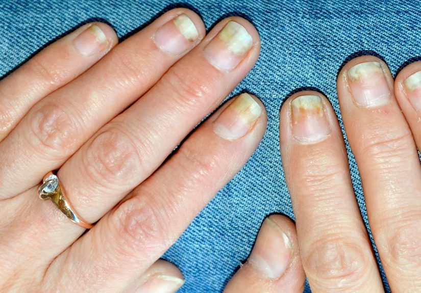 Psoriatic Arthritis Nail Damage: Symptoms and Treatment