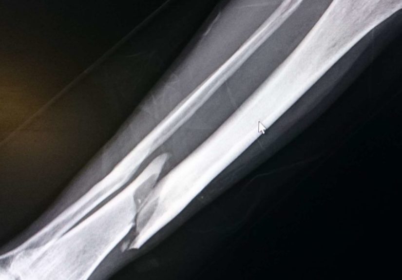 Tibia fracture: Types, symptoms, and treatment