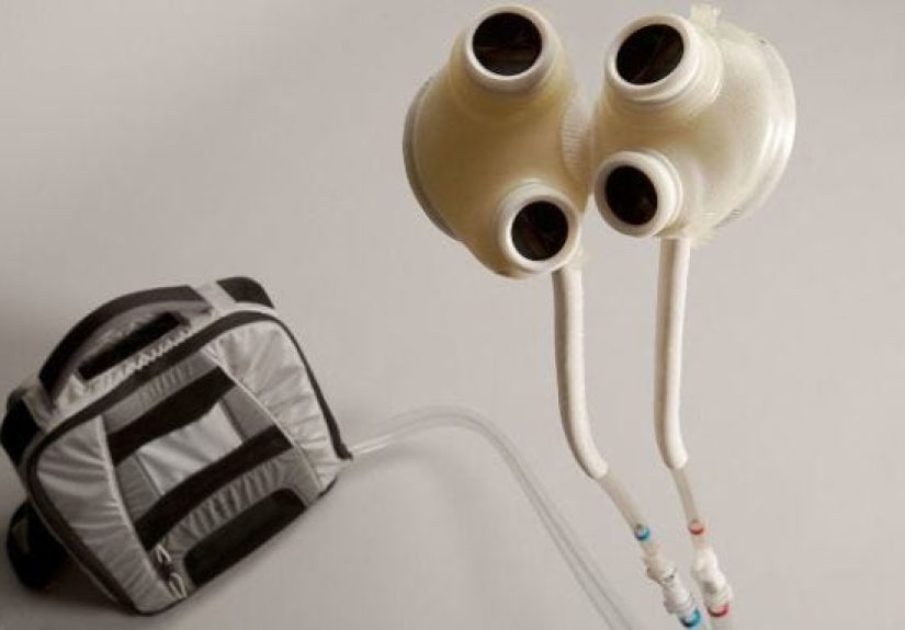 A Man Survived a Whole Year With This Instead of a Heart