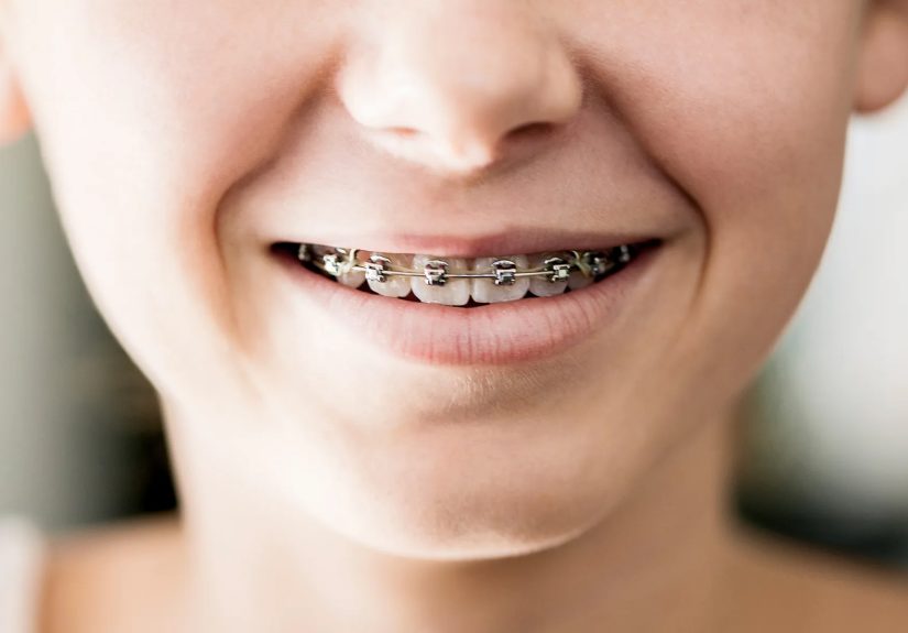 Dental Braces and Retainers: Types, Care, What to Expect