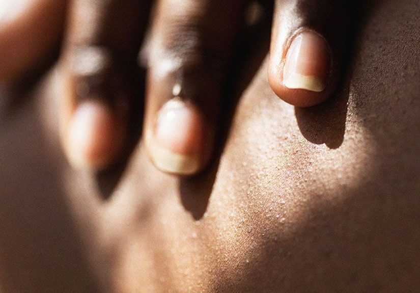 Shingles blister: What they look like and how to treat them