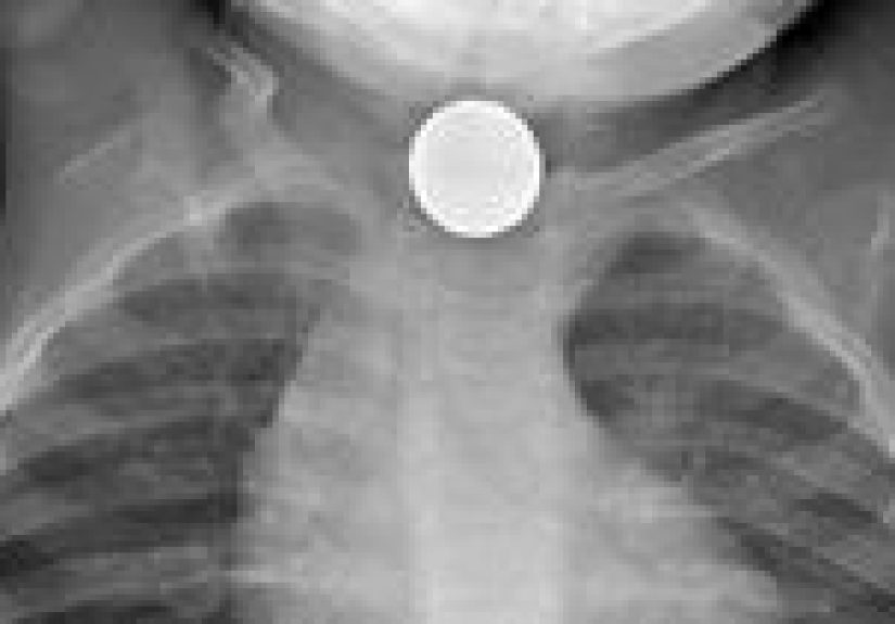 Swallowed (or Inhaled) Foreign Object: Risk Factors and Treatment