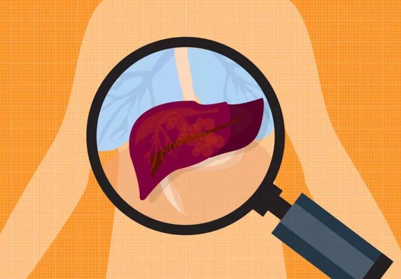 4 Signs of Liver Failure and Prevention Tips