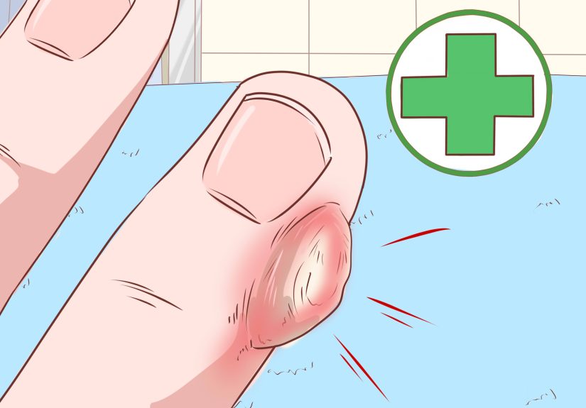 7 Home Remedies to Get Rid of a Writer’s Callus Painlessly