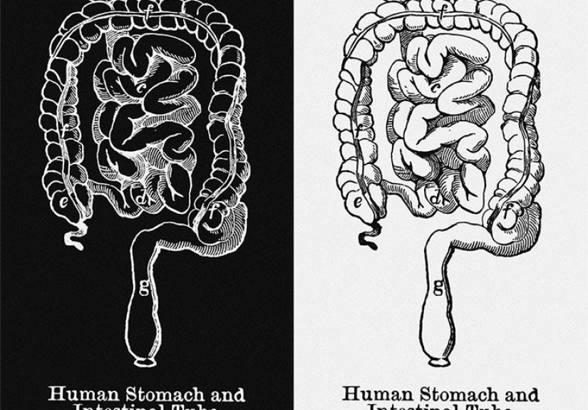 Bowel obstruction: Symptoms, causes, treatment, and diet