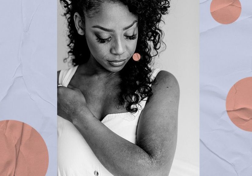 Eczema vs. hives: Differences and more