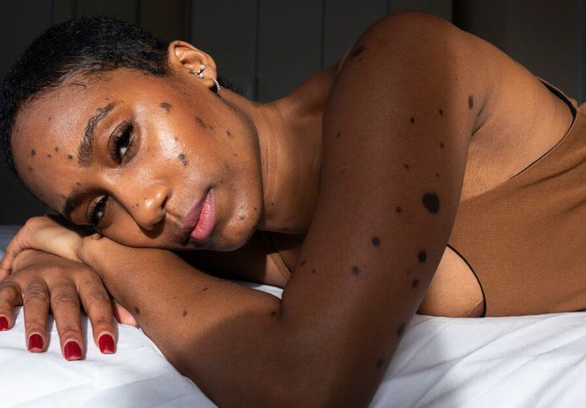 Narcolepsy Diagnosis: Symptoms, Causes, and Tests