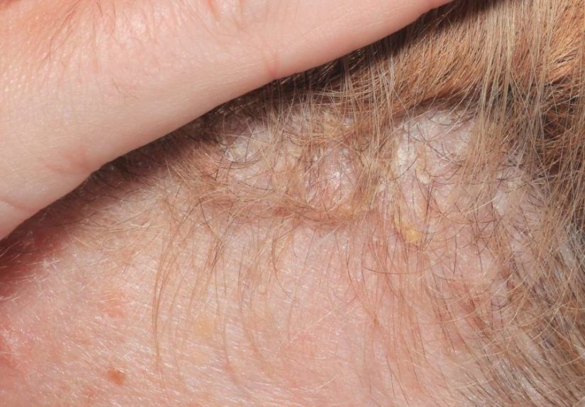 Psoriasis del cuero cabelludo: sÃ­ntomas, causas y tratamiento