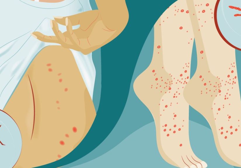 Chigger Bites Vs. Bedbug Bites: Telling Them Apart