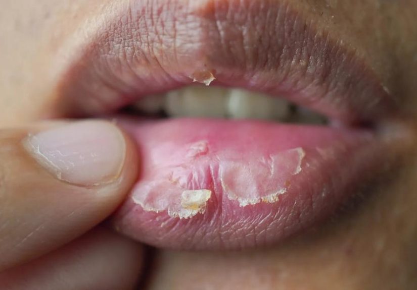 How To Treat Sunburned Lips