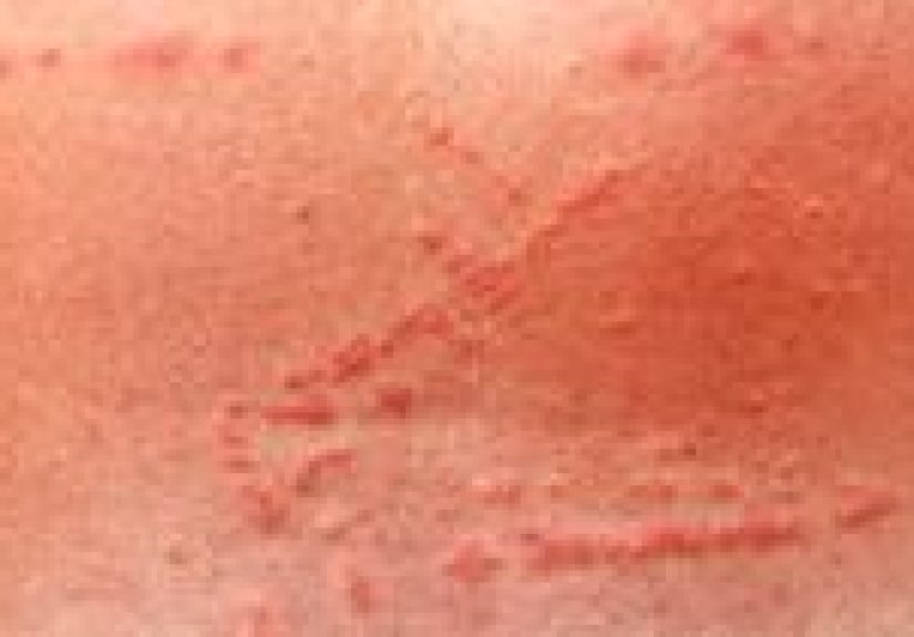 Marine Animal Bites or Stings: Risks, Prevention, and Treatments