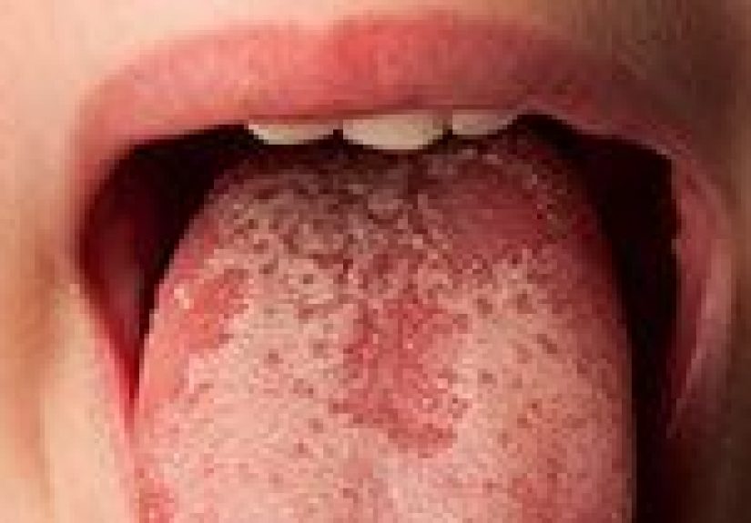 Tongue Problems: Symptoms, Causes, Diagnosis & Treatment
