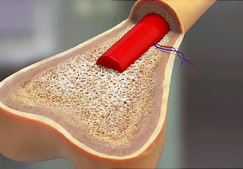 What Is Chronic Lymphocytic Leukemia?