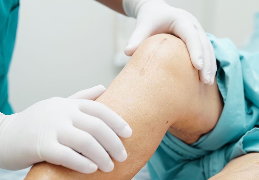 11 Common Knee Replacement Surgery Questions and Answers