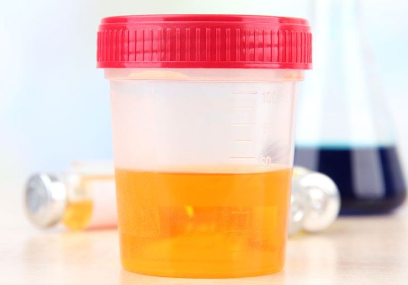 Catecholamine Urine Test: Purpose, Preparation, and Procedure