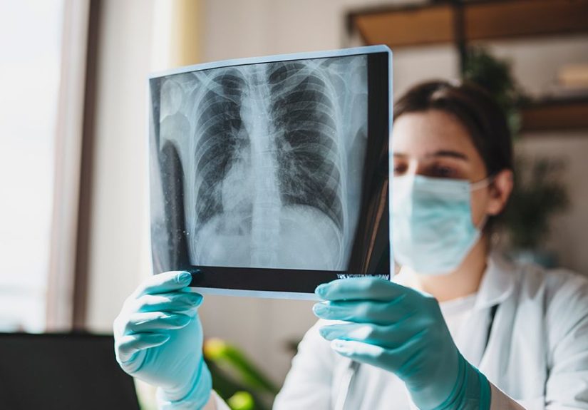 Chest Wall Tumors: Types, Symptoms, Causes, and Treatment