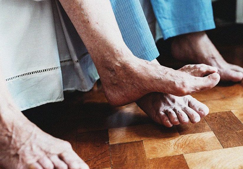 Rheumatoid arthritis (RA): Symptoms, diagnosis, and treatment